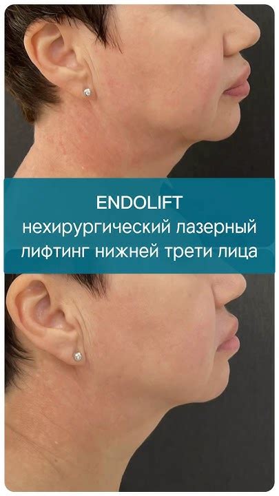 Эндолифт #endolift -результаты нехирургичекого лазерного лифтинга лица ...
