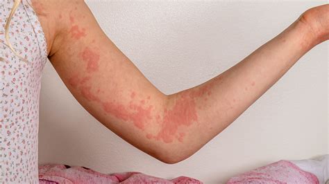 Hives in Children: Urticaria Symptoms and Treatment (for Parents) - GoodRx