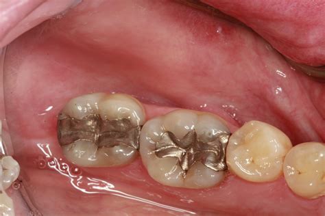 Porcelain Crown Vs. Metal Crown: Making an Informed Decision