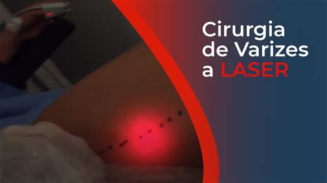 Cirurgia A Laser De Varizes - Cirurgia de varizes a LASER - Dr. Robson Barbosa de Miranda - Cirurgião ...