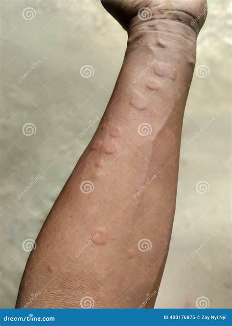 Allergic Skin Lesions Of The Hand With Cracks, Inflammation And Flaking