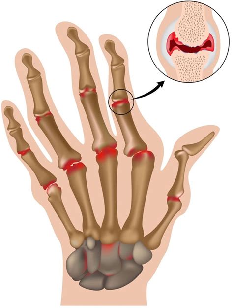 Полиартрит | MedKontrol Мариуполь