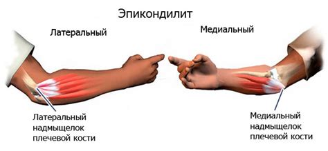Тендинит локтевого сустава (воспаление сухожилий): симптомы и лечение ...