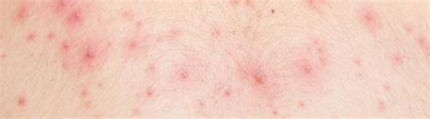 Ano ang gamot sa Bulutong o Chickenpox? | Mediko.PH