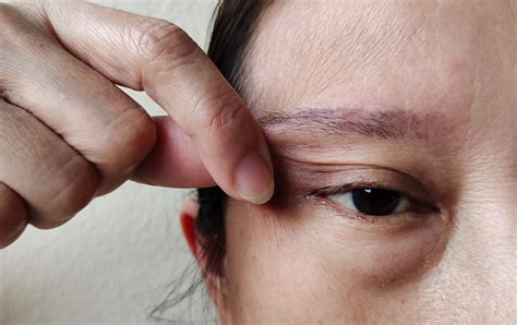 Dull Skin Treatment |Ozmedica Aesthetic Skin Clinic