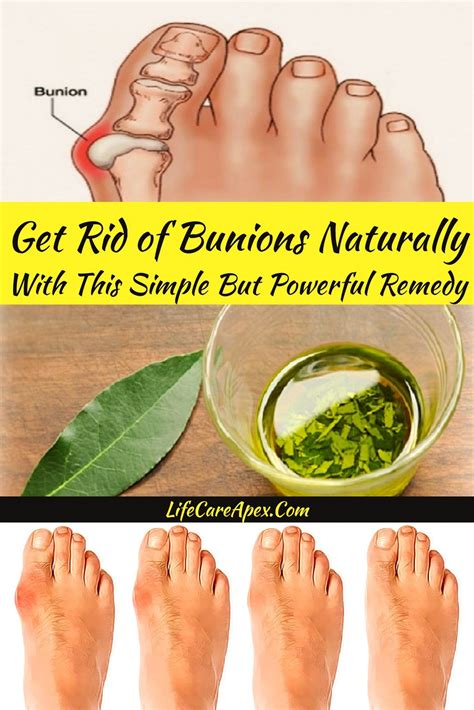 What To Do With Bunion Treatment at Blanca Taylor blog