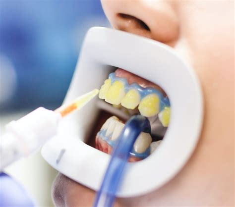 Bleaching – Methoden, Vorteile, Kosten und Haltbarkeit