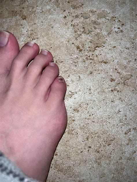 Each of my pinky toenails have had these marks for some time now. I’m