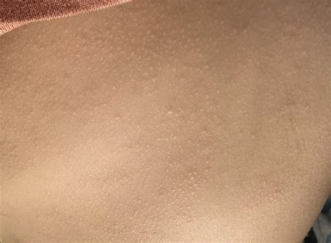 Skin coloured bumps on torso, GP says just dry skin but wont go away