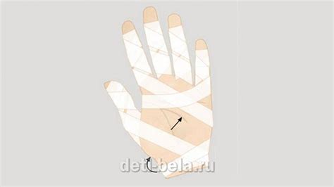 Справочник благотворительного фонда «Дети-бабочки» |Перевязка пальцев ...