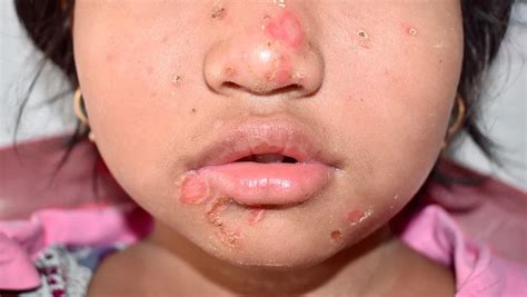 Impetigo: Tips for Treating and Preventing the Spread - Bakersfield ...