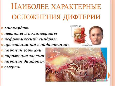 Дифтерия - презентация онлайн