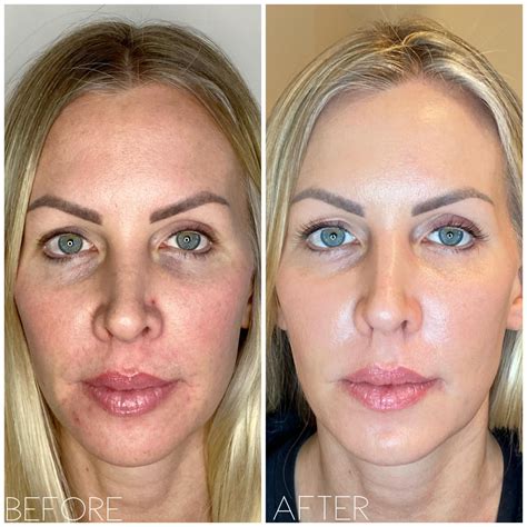 Plasma Fibroblast Under Eye Treatment Reliable Supplier | www