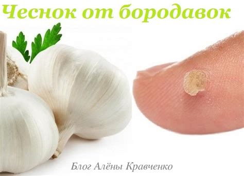 Как вывести бородавку в домашних условиях. 13 народных средств - 100 ...