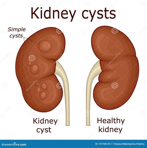 Illustration Of Kidney Cysts Cartoon Vector | CartoonDealer.com #141760125