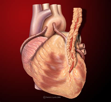 Saphenous vein graft overview - wikidoc