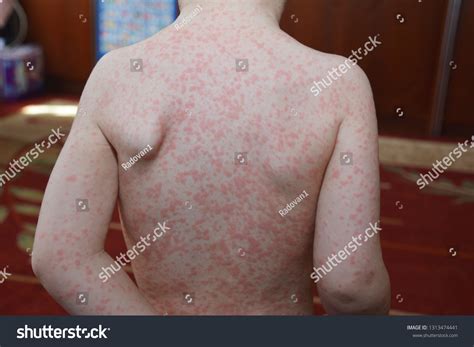 2 Ebv Babies Images, Stock Photos & Vectors | Shutterstock