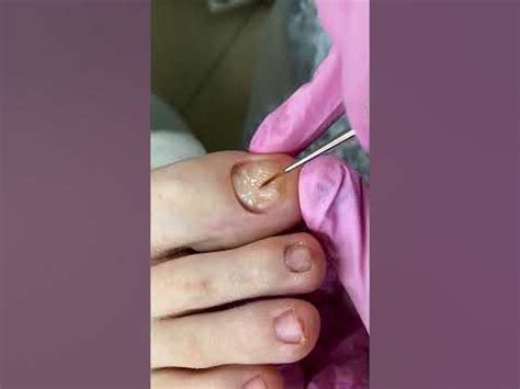 Протезирование ногтей на ногах / Какой гель для протезирования выбрать ...