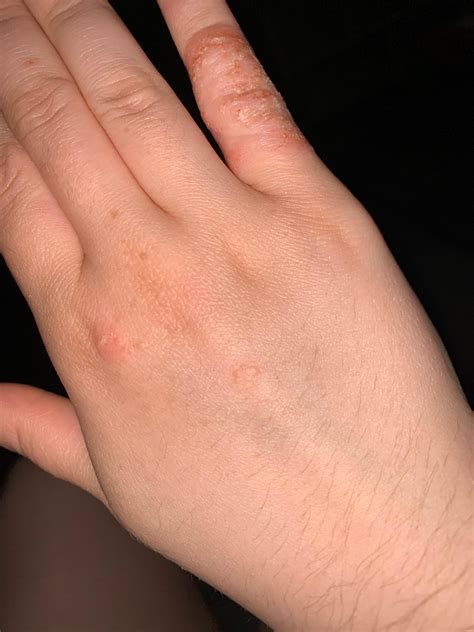 Does this look like scabies? My doctor says it’s eczema but my skin has