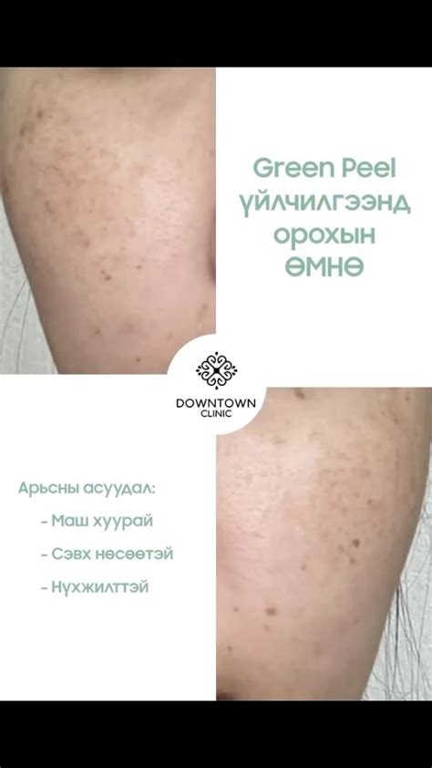 Тай массаж нь эмгүй эмчилгээ бөгөөд олон сар, жил хугацаагаар эдгээгүй ...