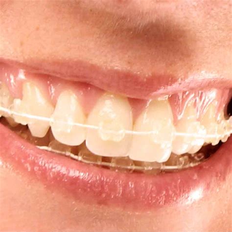 Invisible Braces For Adults Clear Braces And Aligners: Benefits Of