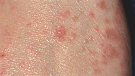 Rashes And Skin Conditions Associated With HIV And AIDS, 51% OFF