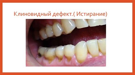 3 курс. Тема № 6-7. Патологическое стирание твердых тканей зубов ...