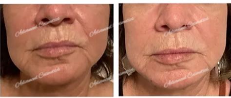 Microcurrent | Advanced Cosmetics