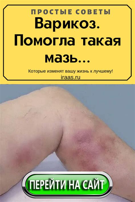 Варикоз.Помогла такая мазь… | Варикоз, Здоровье, Товары для здоровья