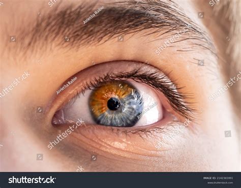 236 Rare Eye Diseases Images, Stock Photos & Vectors | Shutterstock
