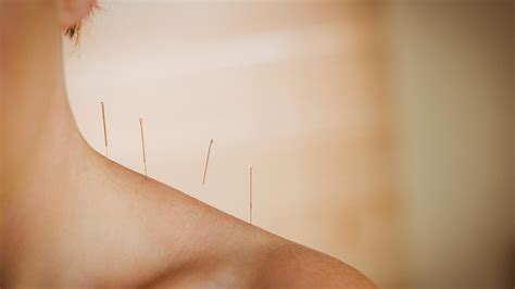 What Are The Benefits of Acupuncture? FAQ, Benefits, & More - Portland ...