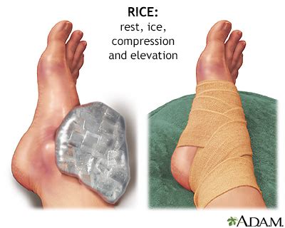 severely sprained ankle treatment