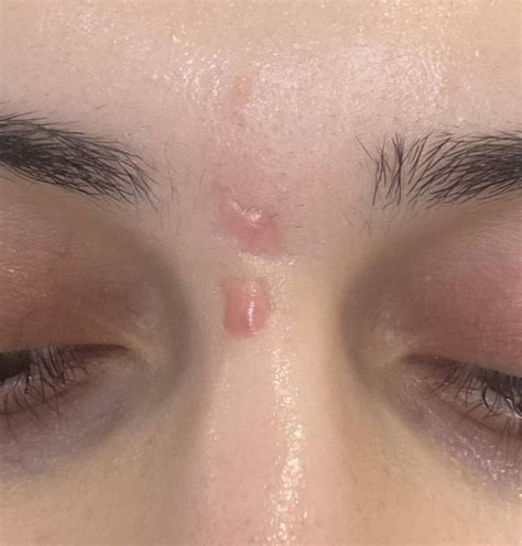 Laser or steroid injection for hypertrophic scar? London : r ...