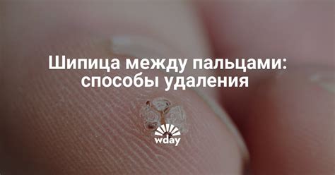 Как избавиться от шипицы на пальце | WDAY