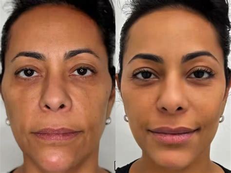 Samantha Schmütz Antes E Depois - Samantha Schmutz faz procedimentos com médico das Kardashians; veja ...