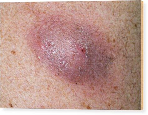 Infected Sebaceous Cyst