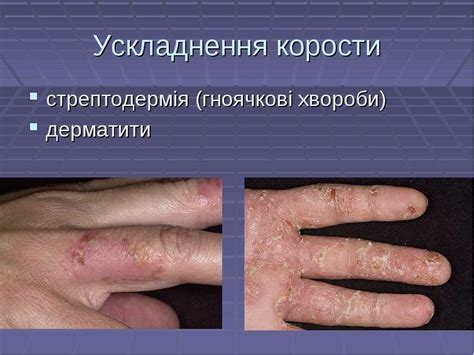 "Короста" - презентація з медицини