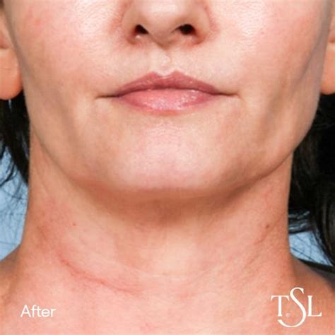 Secret RF Microneedling Treatment | The Skin Lab
