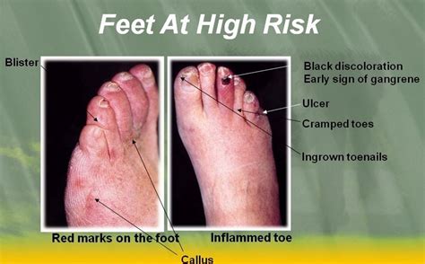 Diabetic toes pictures 1 | Symptoms and pictures