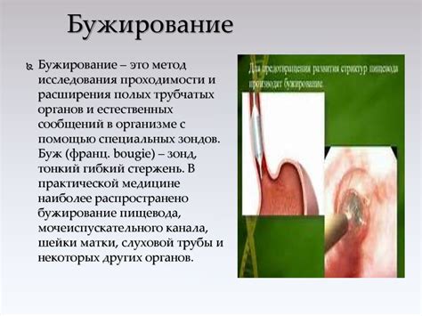 Способы бужирования послеожоговых структур пищевода - презентация онлайн