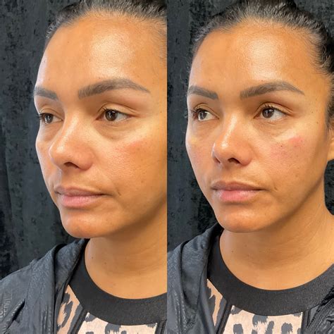 eye fillers  pompano beach brighten smooth  refresh tired