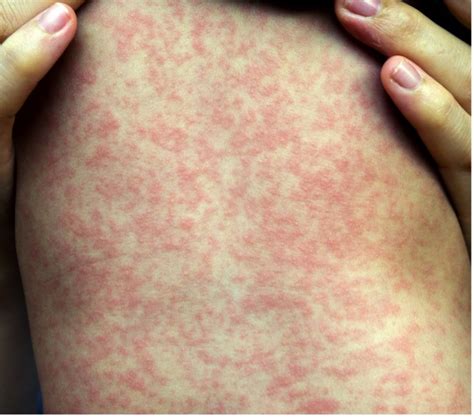Common Viral Infections (exanthem) in Paediatrics - Mind The Bleep