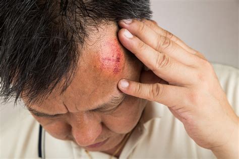 Bump On Head Cancer - IFHNOS Auckland 2016 | Australian Head