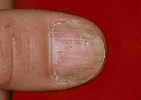 Hand Nail Fungus
