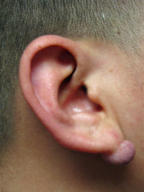 how to get rid of lump in earlobe 3