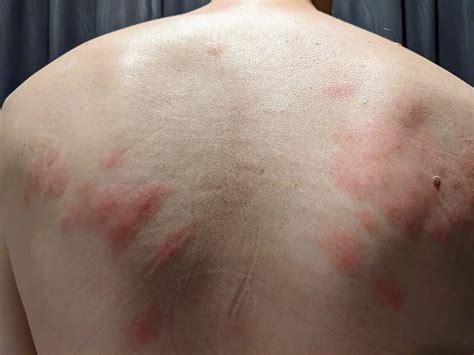 Itchy Red Skin After Exercise: Soothing Tips & Tricks
