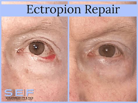 Ectropion/Entropion Before & After Gallery | Schlessinger Eye & Face