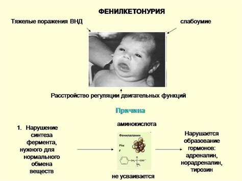 Диета при фенилкетонурии у детей
