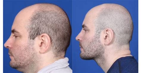 hombre de  anos se quita la papada  ahora tiene una cita cada semana