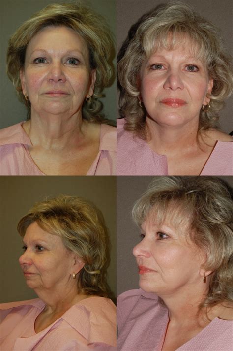 Facial Augmentation (Implants) Before & After Photos | Renaissance ...